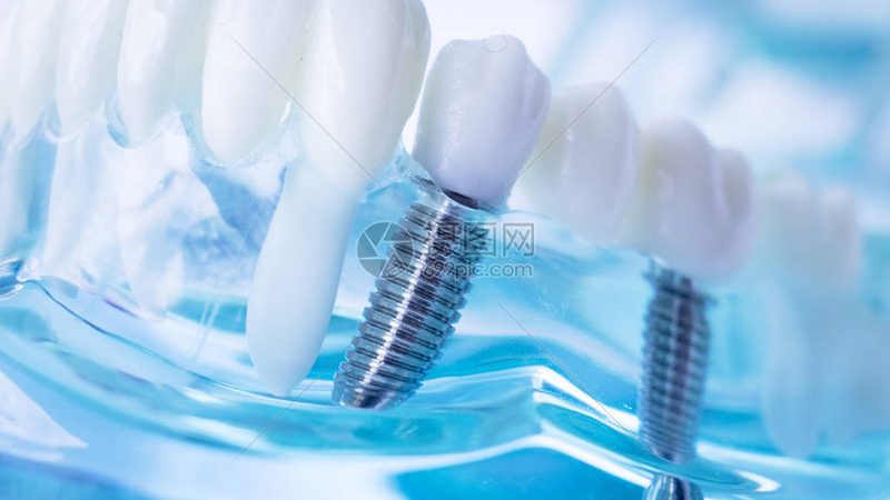 全麻儿童牙科治疗：风险解析与注意事项